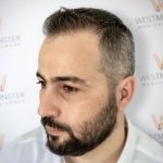 FUE-Hair-Transplant-UK-Westminster-Medical-Group-London-After2-2