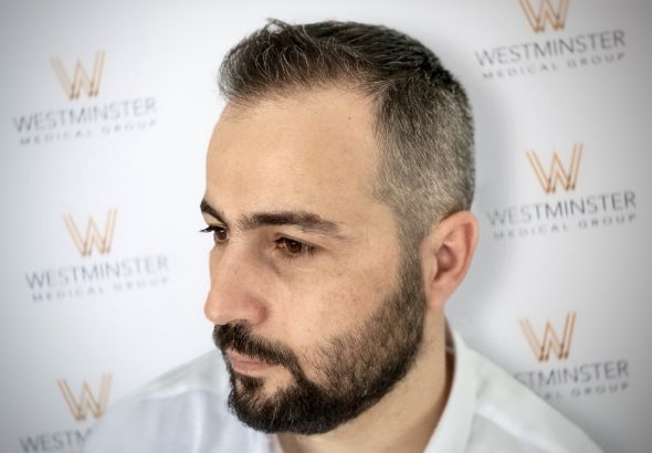 FUE-Hair-Transplant-UK-Westminster-Medical-Group-London-After2-2